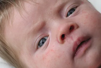 Сыпь на теле ребенка – в чем причины? Как определить аллергию, инфекции,  дерматиты | О детском здоровье: с врачебного на родительский | Дзен