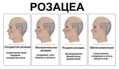 Что такое розацеа кожи: причины, симптомы, классификация, как лечить |  Лазерсвiт