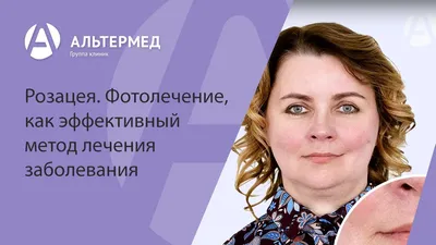 Лечение розацеа лазером – цены на услугу в Химках, Эстетика Групп (Москва и  МО)