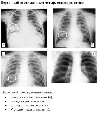 Туберкулёз. Туберкулёз кожи. Туберкулёз глаз. Туберкулёзный перикардит. + |  Портал радиологов