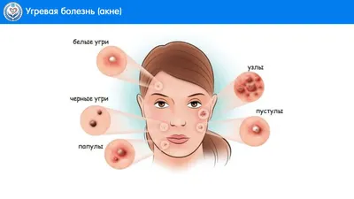 Как избавиться от Папилломавирусной инфекции (ВПЧ) на лице: причины,  симптомы, классификация, стадии, диагностика и лечение ВПЧ