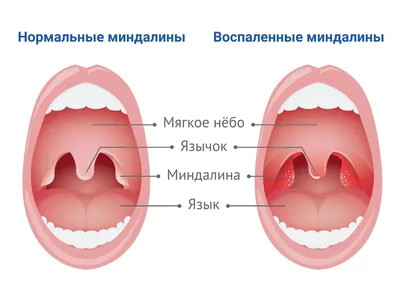 Доктор Тобиас - Паратонзиллярный абсцесс - это воспалительный процесс  возникающий в клетчатке вокруг небной миндалины, который приводит к  образованию гнойной полости и развитию обширного воспалительного процесса.  ⠀ Часто паратонзиллярный абсцесс ...