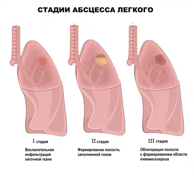 Лечение тонзиллита в Москве лазером - цена от 2500 руб