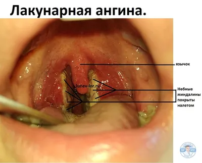 Тонзиллэктомия - операция по удалению миндалин | Лечение тонзиллита