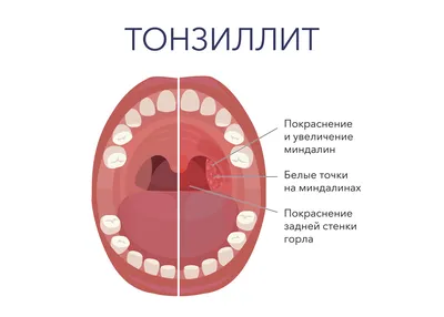 Перфорация перегородки носа: симптомы, лечение, реабилитация