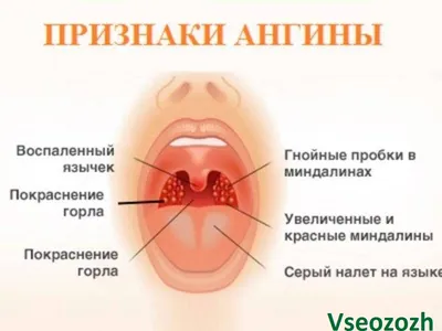 Delicat - 🗣 Паратонзиллярный абсцесс – острый воспалительный процесс  околоминдаликовой клетчатки инфекционного характера, возникающий в  следствии острого тонзиллита или обострения хронического. В редких случаях  заболевание провоцируют кариозные зубы ...