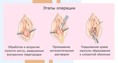 Иллюстрация 11 из 16 для Ошибки и осложнения в урогинекологии - Пушкарь,  Касян | Лабиринт - книги. Источник: