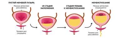 Рак мочевого пузыря | Статьи клиники \"УРО-ПРО\"