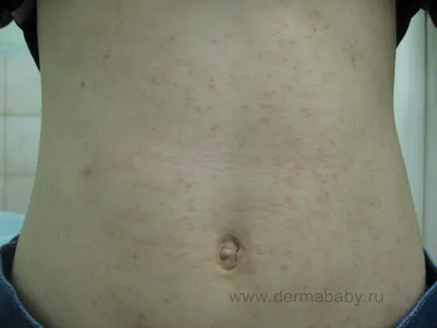 Паразитарные заболевания кожи: чесотка, вшивость, микозы