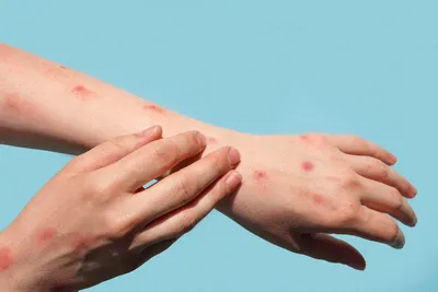 Vegapharm Tajikistan - Грибковые заболевания занимают первое место среди  инфекций. Грибковые заболевания кожи (микозы) — это инфекционные заболевания,  вызванные болезнетворными грибами. Микозы заразны, возбудители заболевания  передаются при ...