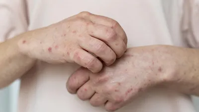 Синдром Экбома или паразиты под кожей | Анамнез | Дзен