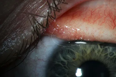 Смотри Какие паразиты живут в глазах . . Подробно в видео ↗️ Подпишись и  ставь ❤Здесь много полезного Тригельм» – это трехфазная… | Instagram