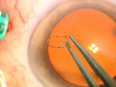 Смотри Какие паразиты живут в глазах . . Подробно в видео ↗️ Подпишись и  ставь ❤Здесь много полезного Тригельм» – это трехфазная… | Instagram