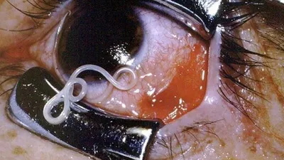 Видеофакт не для слабонервных: из глаза мужчины достали 15-сантиметрового  червя