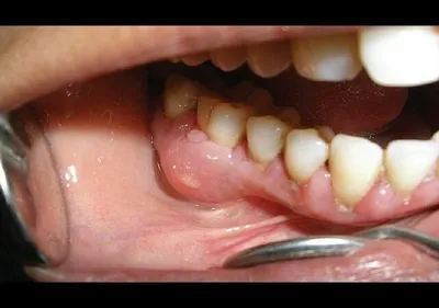 Абсцесс зуба: симптомы и лечение в домашних условиях