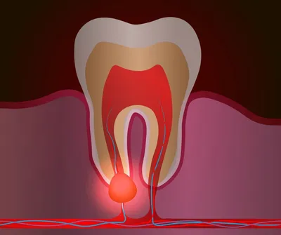 Как проходит лечение пародонтального абсцесса? | СКАЙКЛИНИК