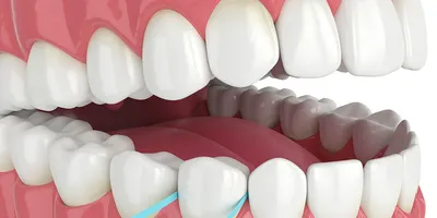 Гингивэктомия - Сеть стоматологических клиник Санкт-Петербурга - Мир  стоматологии