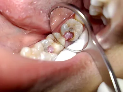 32 Margarit Dental Clinic - Гипертрофический гингивит, симптомы и лечение.  Гипертрофическим гингивитом называют такое хроническое воспаление десны,  которое сопровождается реактивным разрастанием волокнистой соединительной  ткани и базальных клеток ...