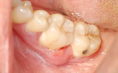 Зубная боль и инфекция - Стоматологическая патология - Справочник MSD  Профессиональная версия
