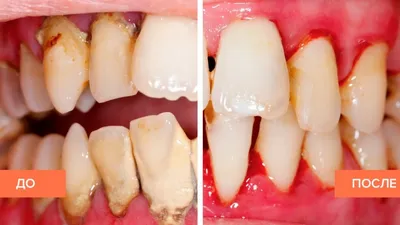 Риски и преимущества зондирования вокруг зубов и дентальных имплантатов  (2425) - Стоматология - Новости и статьи по стоматологии - Профессиональный  стоматологический портал (сайт) «Клуб стоматологов»