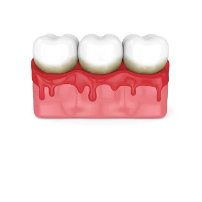Десневой карман - причины возникновения, методы лечения в Colibri Dental