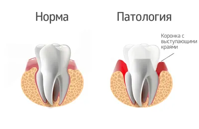 Удаление зуба и пародонтальный карман - Хирургическая стоматология -  Стоматология для всех