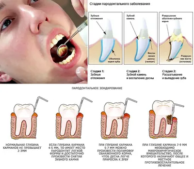 Пародонтоз, лечение в Раменках. Причины, симптомы и самые эффективные  методы лечения пародонтоза десен.