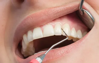 Что такое пародонтальный карман: когда полости между зубом и десной  становятся опасны. Как распознать патологию и вылечить? |  ortodontcomplex.ru | Дзен