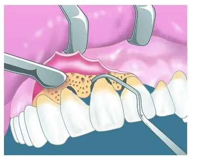 Что такое пародонтальный карман: когда полости между зубом и десной  становятся опасны. Как распознать патологию и вылечить? |  ortodontcomplex.ru | Дзен