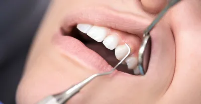 Кюретаж кармана, Уфа, записаться на консультацию к стоматологу |  Стоматология Милленниум клиник