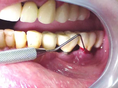 Кюретаж пародонтального кармана десен: открытый и закрытый в стоматологии в  Феодосии