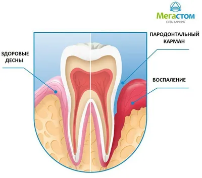 Пародонтальный абсцесс - вопросы лечения - parodont.pro