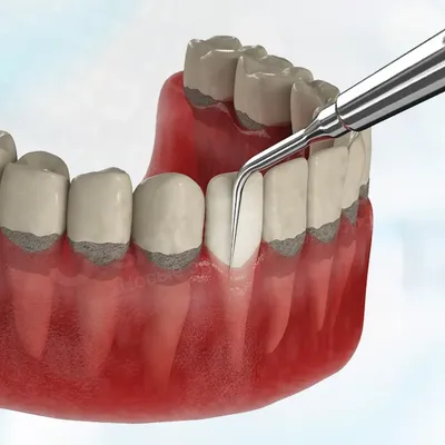 Протезирование зубов при пародонтите | Мегастом - сеть клиник