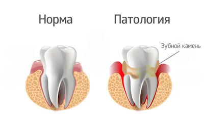 Карман в десне между зубами: 10 признаков того, что необходимо начинать  лечение