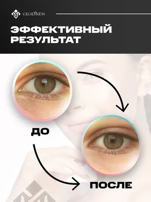 😍Патчи с растворимыми микроиглами (Micro needle eye patch) Отличная  домашняя процедура👍👍👍 🌿Омолаживающие патчи на основе гиалуроновой… |  Instagram