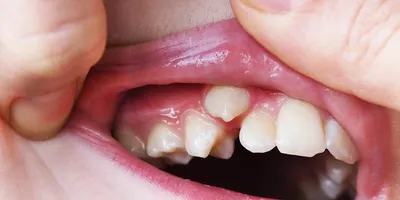 Аномалии (патологии) зубов - причины, классификация, диагностика, лечение