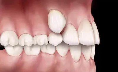 Аномалии развития детских зубов - симптомы и лечение – статьи детской  стоматологической клиники «Мартинка»