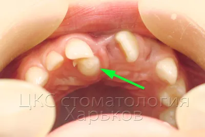 О стоматологии и не только...: Свехкомплектные зубы (лишние зубы)