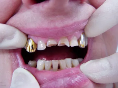 Файл:Dental abrasion 2007.jpg — Википедия