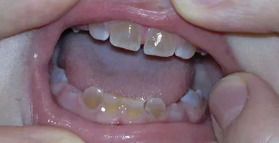 Стираемость Зубов
