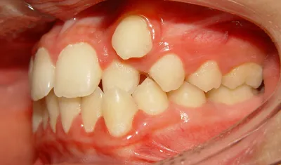 Сверхкомплектные зубы: причины патологии и пути лечения | Dental Art