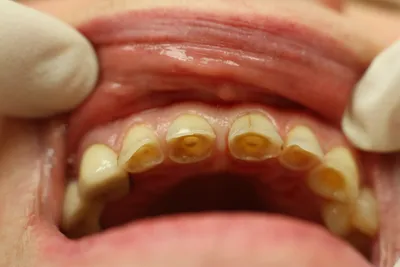 Патологическая стираемость зубов: лечение, фото | Dental Art
