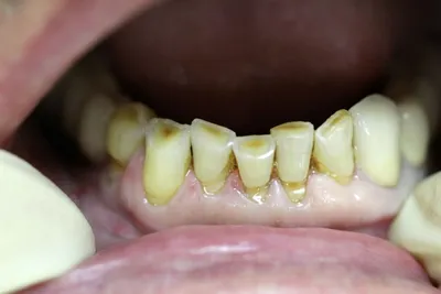 патологическая подвижность зубов – причины, степени, современные методы  лечения