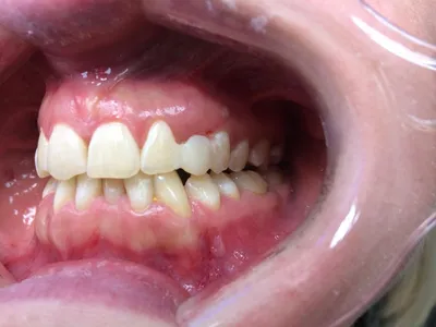 Пример работы: Жалобы на сильное разрушение зубов, затрудненность в  пережевывании пищи