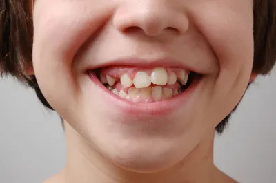 Окклюзия зубов: причины нарушения, симптомы, диагностика и лечение в  стоматологии