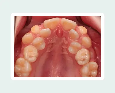 Болезни зубов у человека: Патологии прорезывания и формирования зубов —  Стоматология «Доктор НеболитЪ»