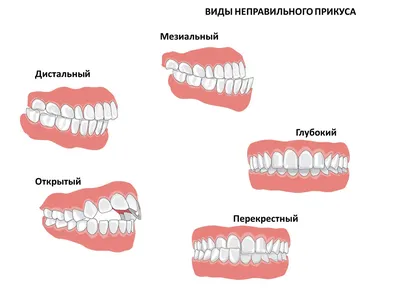 Самые распространённые патологии прикуса