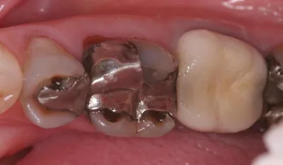 Тяжелый генерализованный пародонтит и патология прикуса - Стоматология  «Magic Dental» в Санкт-Петербурге