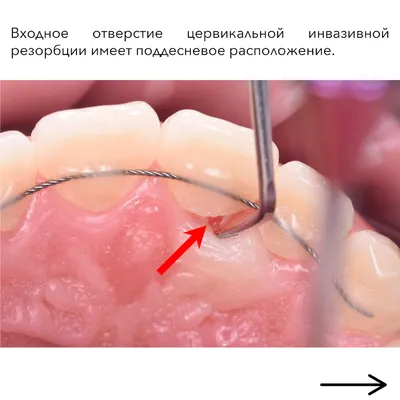 Клиновидный дефект зубов – как лечить? | Москва