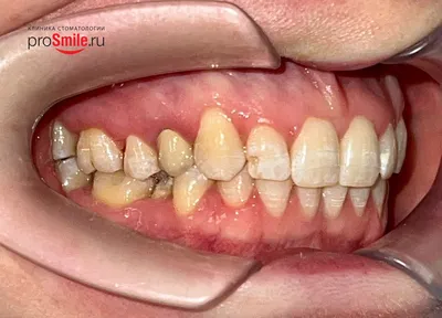 Брекеты на нижнюю челюсть в Омске, цены на установку в стоматологии  «Ортодонт-центр»
